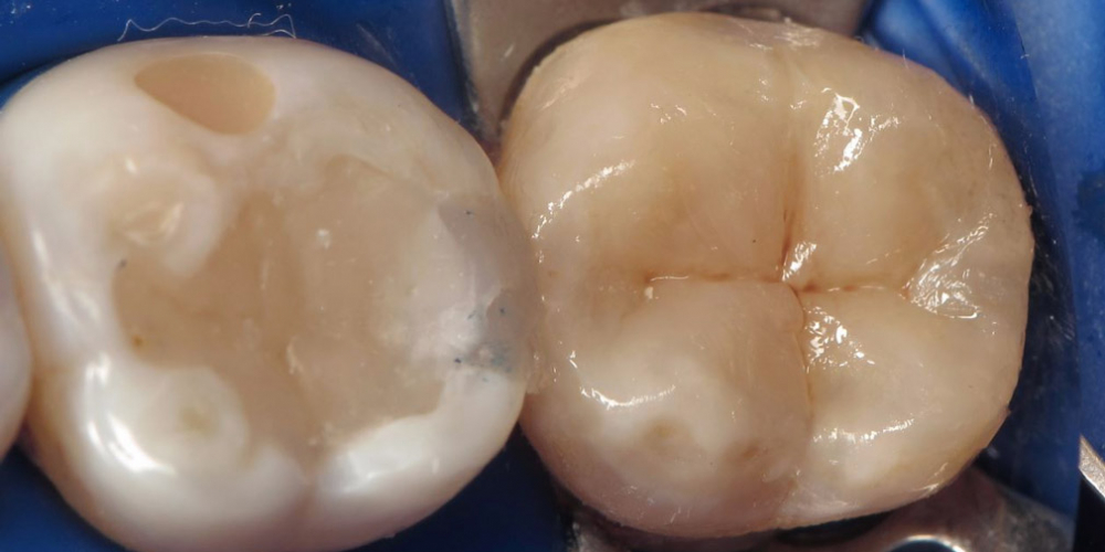 Первым этапом проводилось моделирование дентинной основы, затем перекрытие зуба и создание морфологии эмалевым слоем. Подчеркивания глубины фиссур композитными красками. Лечение кариеса зуба, восстановления анатомии зуба композитным материалом