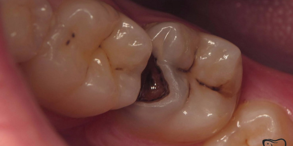  Непрямая композитная реставрация жевательного зуба