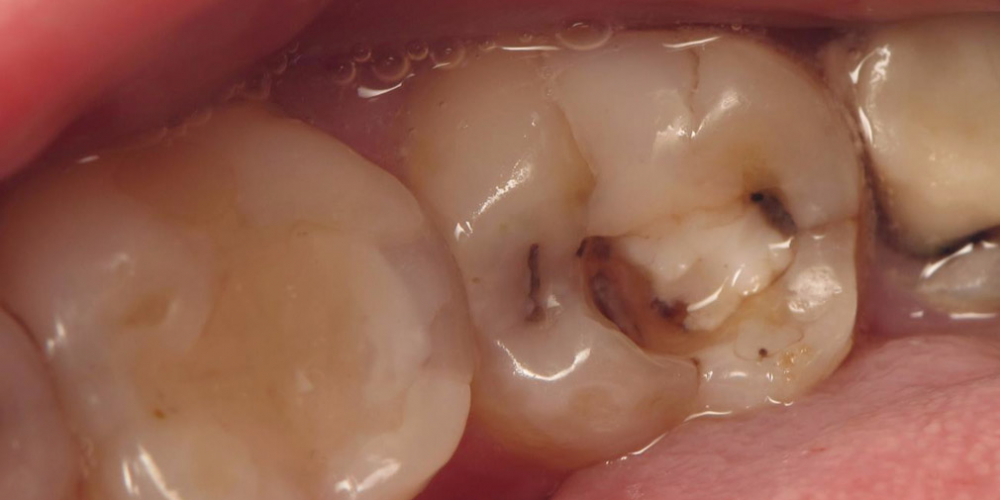 Фото до лечения кариеса. Лечение кариеса зуба, восстановления анатомии зуба композитным материалом