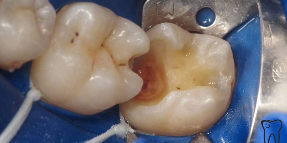  Непрямая композитная реставрация жевательного зуба