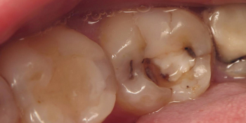 Лечение кариеса зуба, восстановления анатомии зуба композитным материалом фото до лечения